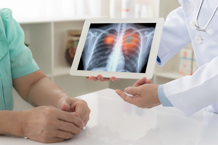 lung-cancer-in-the-elderly