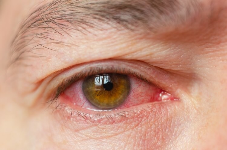 causes of red eyes
