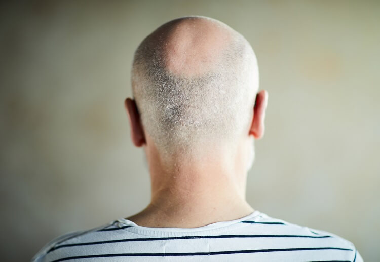 remedy-hair-loss-in-elderly