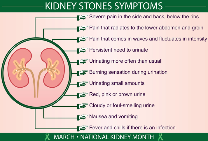 Kidney-Stones-Symptoms