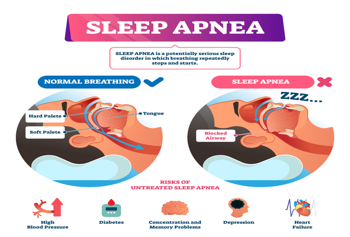 sleep-apnea