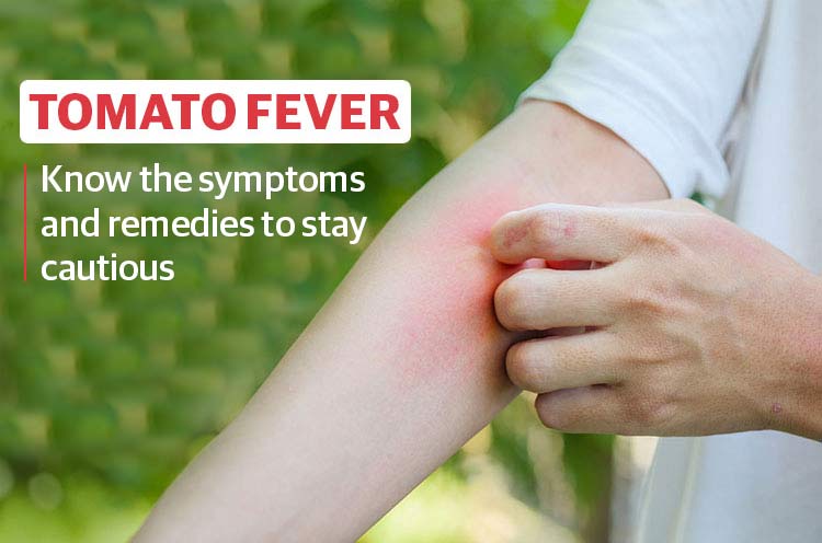 what-is-tomato-fever-and-its-symptoms-prevention-treatment
