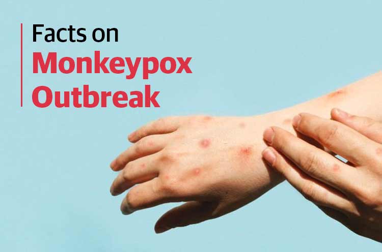 Facts on Monkeypox Outbreak