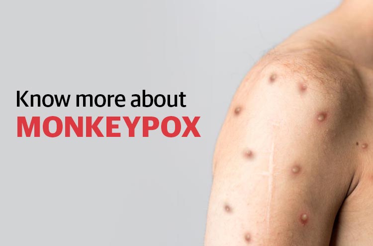 Know more about Monkeypox blog
