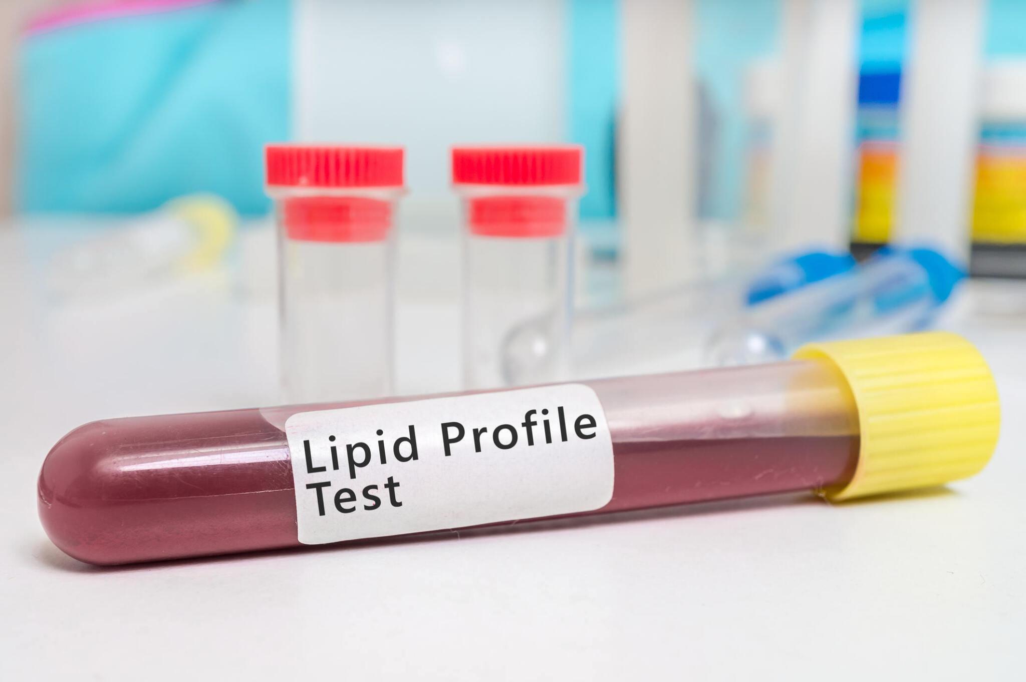 Lipid Profile Test